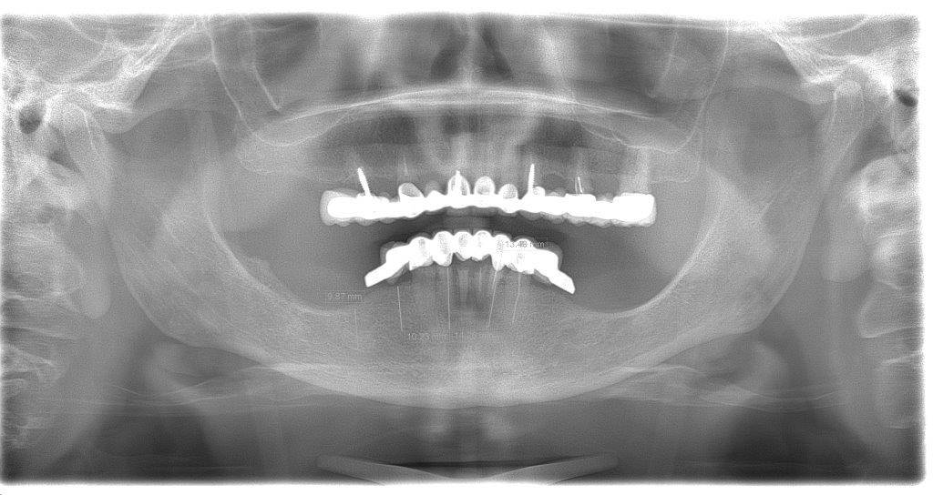 Пациентка Л. обратилась в клинику с просьбой провести имплантацию двух челюстей.