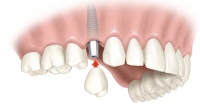 Сохранить зуб или установить имплантат?