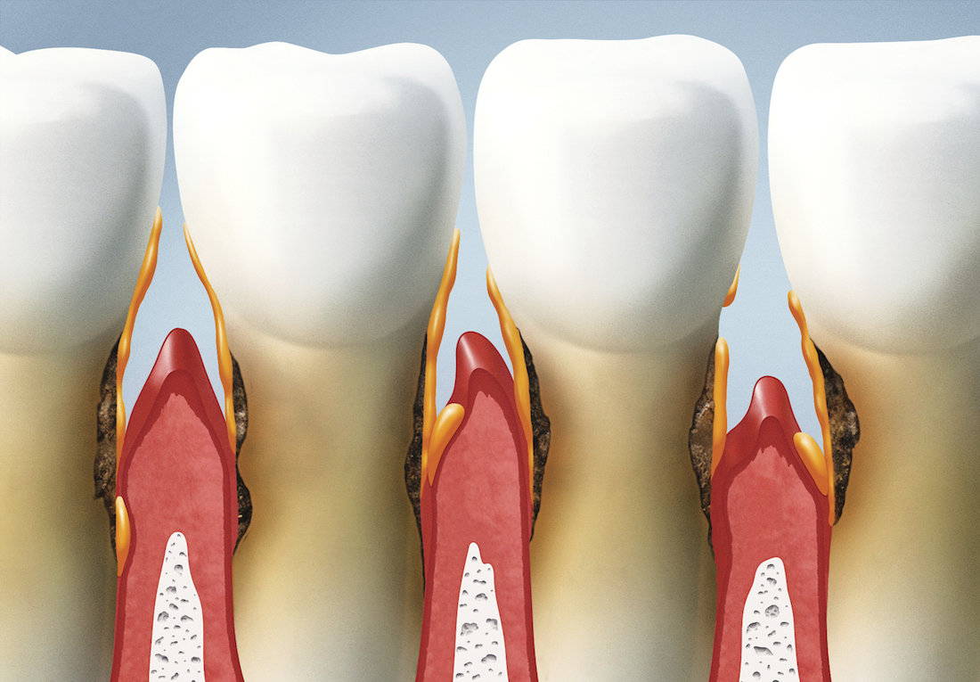 Как избавиться от зубного камня и сохранить здоровые зубы