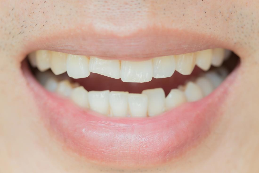 пример отколовшегося зуба