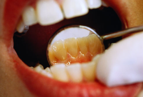 зубы пациента на осмотре