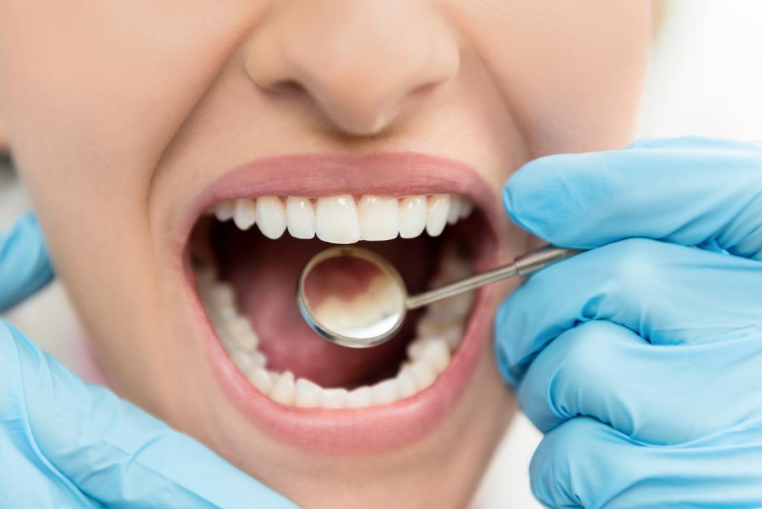 Женщина с полостями в зубах, на осмотре стоматолога