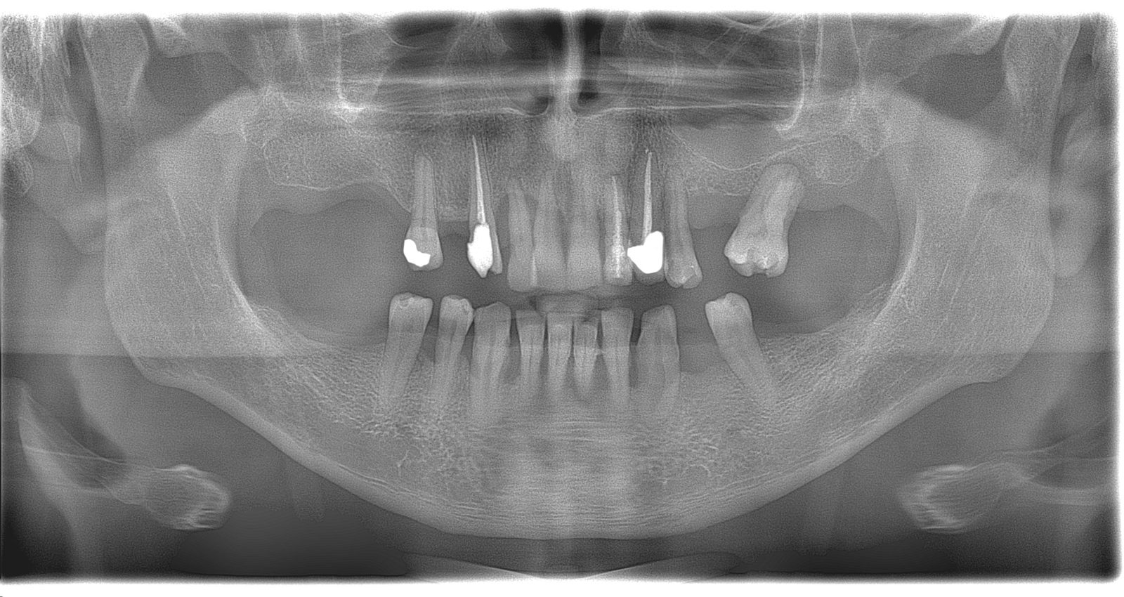 скан челюсти после операции