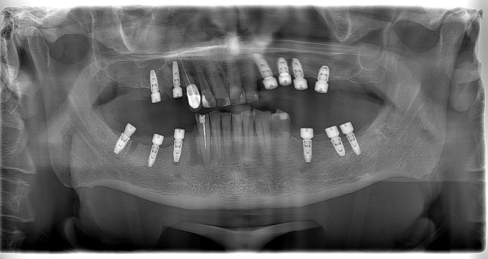 фото зубов до операции