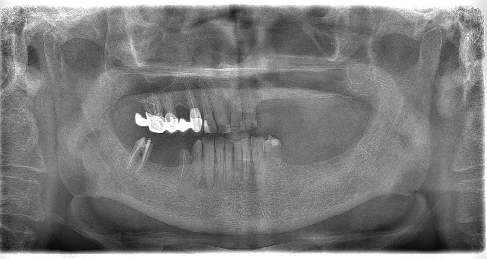 фото зубов после операции